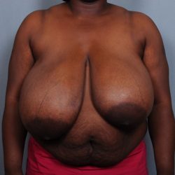 Breast Reduction Before & After Patient #2000