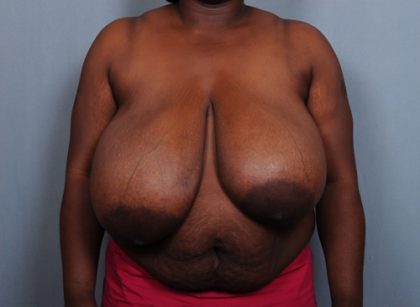 Breast Reduction Before & After Patient #2000