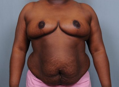 Breast Reduction Before & After Patient #2000