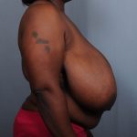 Breast Reduction Before & After Patient #2000