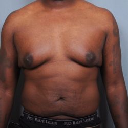 Male Breast Reduction Before & After Patient #2004