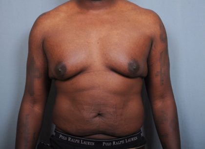 Male Breast Reduction Before & After Patient #2004