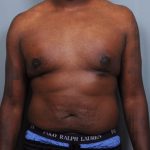 Male Breast Reduction Before & After Patient #2004