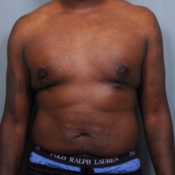 Male Breast Reduction Before & After Patient #2004
