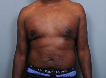 Male Breast Reduction Before & After Patient #2004