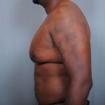 Male Breast Reduction Before & After Patient #2004