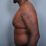 Male Breast Reduction Before & After Patient #2004