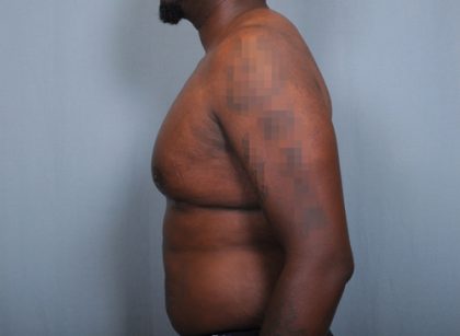 Male Breast Reduction Before & After Patient #2004