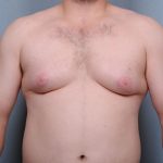 Male Breast Reduction Before & After Patient #2003
