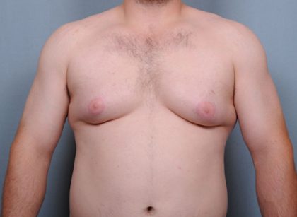 Male Breast Reduction Before & After Patient #2003