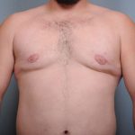 Male Breast Reduction Before & After Patient #2003