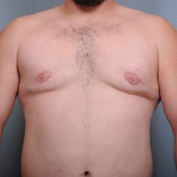 Male Breast Reduction Before & After Patient #2003