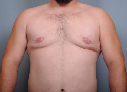 Male Breast Reduction Before & After Patient #2003