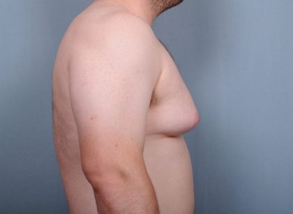 Male Breast Reduction Before & After Patient #2003