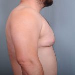 Male Breast Reduction Before & After Patient #2003