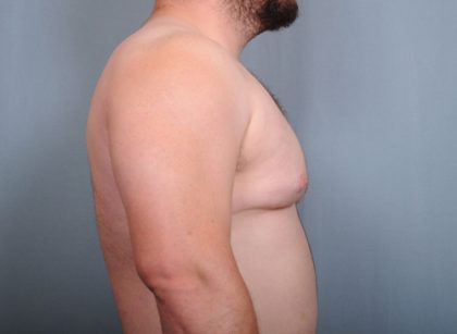 Male Breast Reduction Before & After Patient #2003