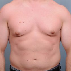 Male Breast Reduction Before & After Patient #2002