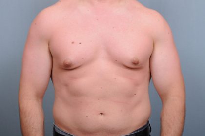 Male Breast Reduction Before & After Patient #2002