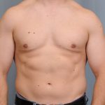 Male Breast Reduction Before & After Patient #2002