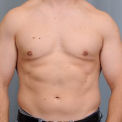 Male Breast Reduction Before & After Patient #2002