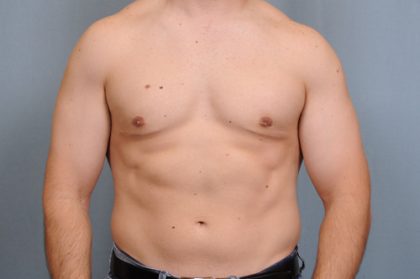 Male Breast Reduction Before & After Patient #2002