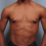 Male Breast Reduction Before & After Patient #2001