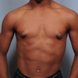 Male Breast Reduction Before & After Patient #2001