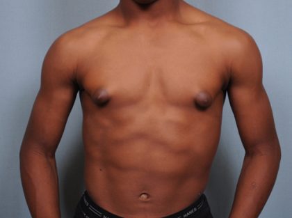 Male Breast Reduction Before & After Patient #2001