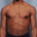 Male Breast Reduction Before & After Patient #2001