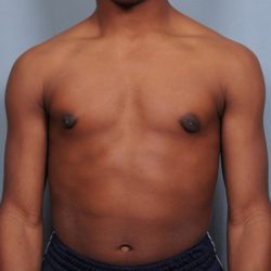 Male Breast Reduction Before & After Patient #2001