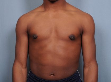 Male Breast Reduction Before & After Patient #2001