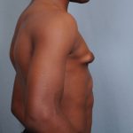 Male Breast Reduction Before & After Patient #2001