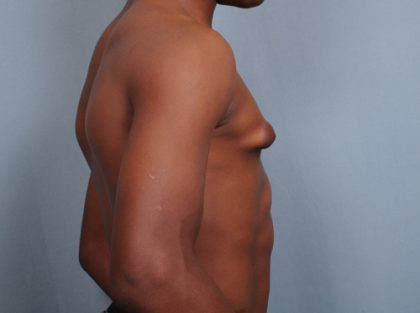 Male Breast Reduction Before & After Patient #2001