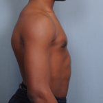 Male Breast Reduction Before & After Patient #2001