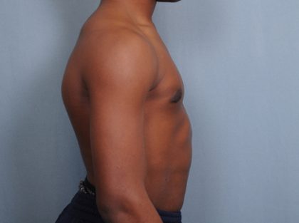 Male Breast Reduction Before & After Patient #2001