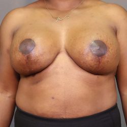 Implant Exchange Before & After Patient #3119