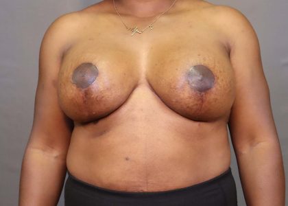 Implant Exchange Before & After Patient #3119