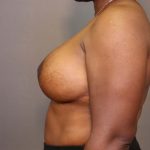 Implant Exchange Before & After Patient #3119