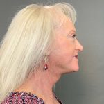 Facelift Before & After Patient #4449