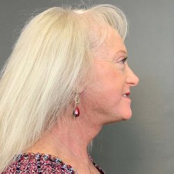Facelift Before & After Patient #4449