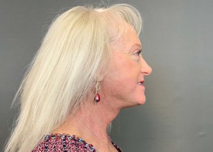 Dermabrasion Before & After Patient #4452