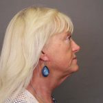 Dermabrasion Before & After Patient #4452