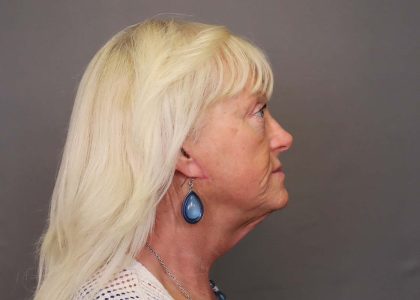 Dermabrasion Before & After Patient #4452