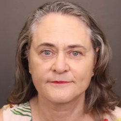 Facelift Before & After Patient #3617
