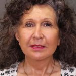 Facelift Before & After Patient #3225