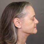 Facelift Before & After Patient #3617