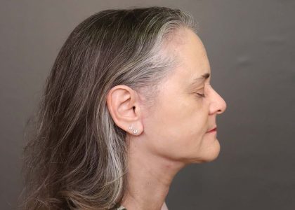 Facelift Before & After Patient #3617