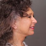 Facelift Before & After Patient #3225
