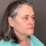 Facelift Before & After Patient #3617