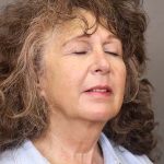 Facelift Before & After Patient #3225
